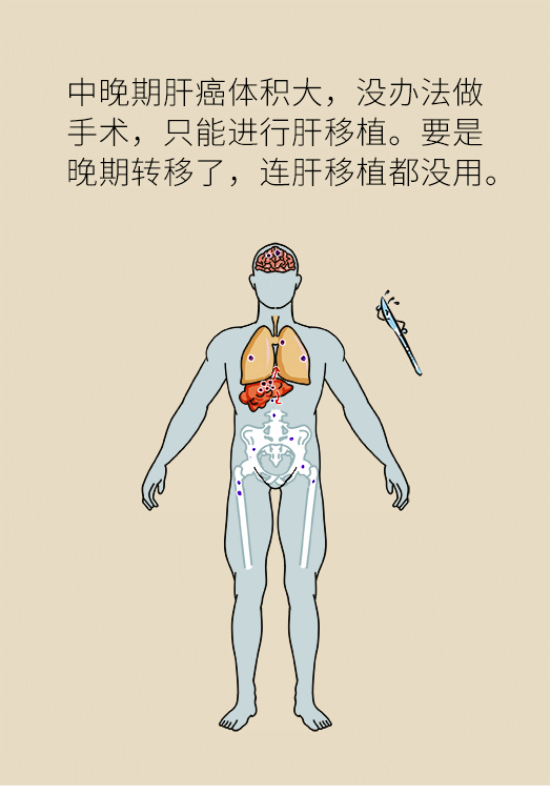 論發(fā)現(xiàn)早期肝癌的本事，cfDNA比AFP更精準，比影像學更早一步