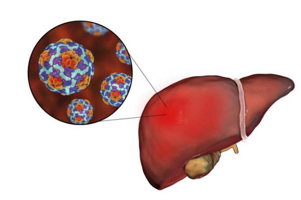 世界肝炎日：得了肝炎一定會(huì)得肝癌嗎？