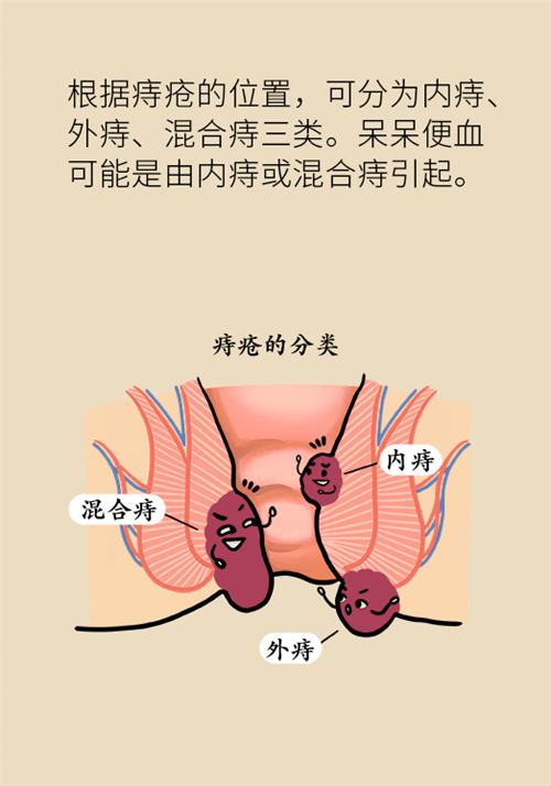 肛門(mén)腫脹還有血？小心痔瘡找上門(mén)