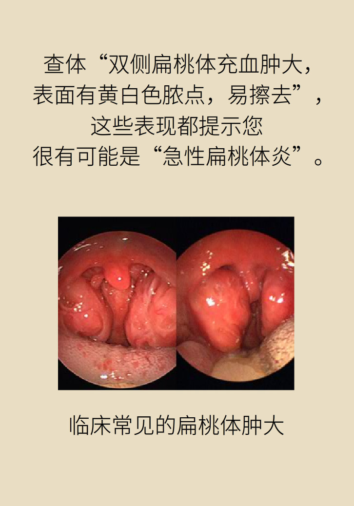 單側(cè)扁桃體腫大更兇險(xiǎn)！謹(jǐn)防惡性腫瘤