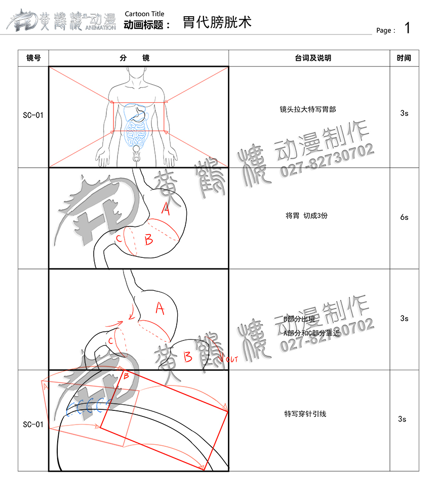 胃代膀胱術醫(yī)療手術動畫制作.jpg