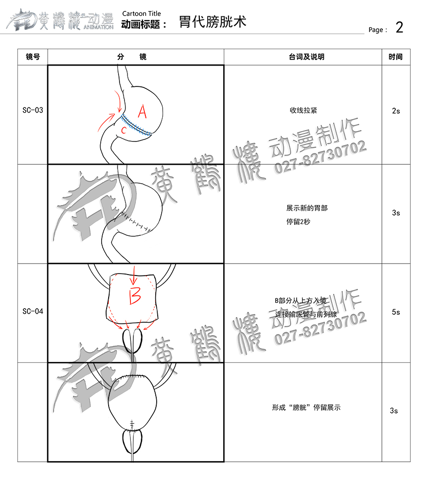 胃代膀胱術醫(yī)療手術動畫制作2.jpg